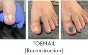 Nail Reconstruction